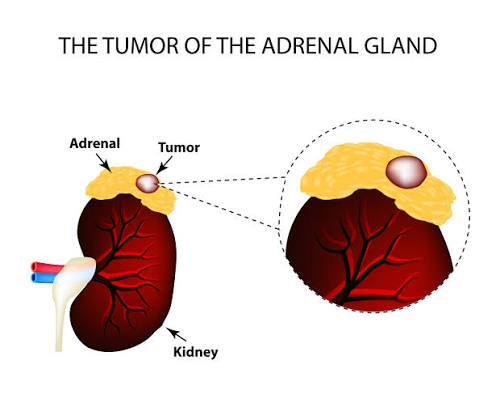 Diagram of The Tumor of The Adrenal Gland