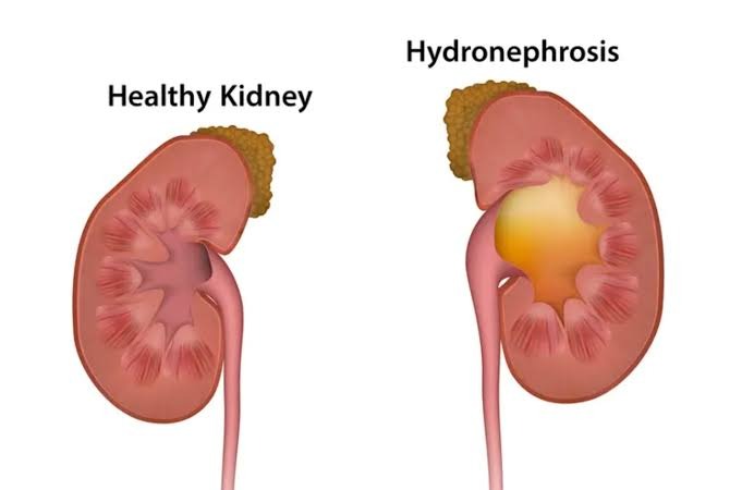 Healthy Kidney vs Hydronephrosis Diagram